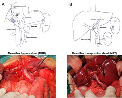 Meso-Rex bypass shunt vs. transposition shunt for cavernous transformation of portal vein in children